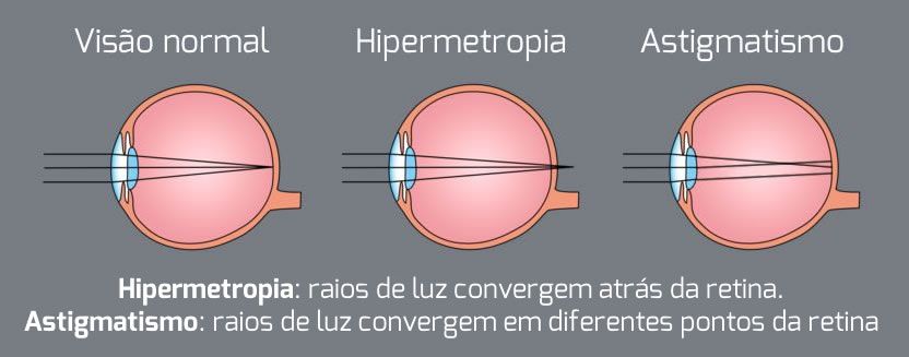 HIPERMETROPIA OTICA EM GOIANIA